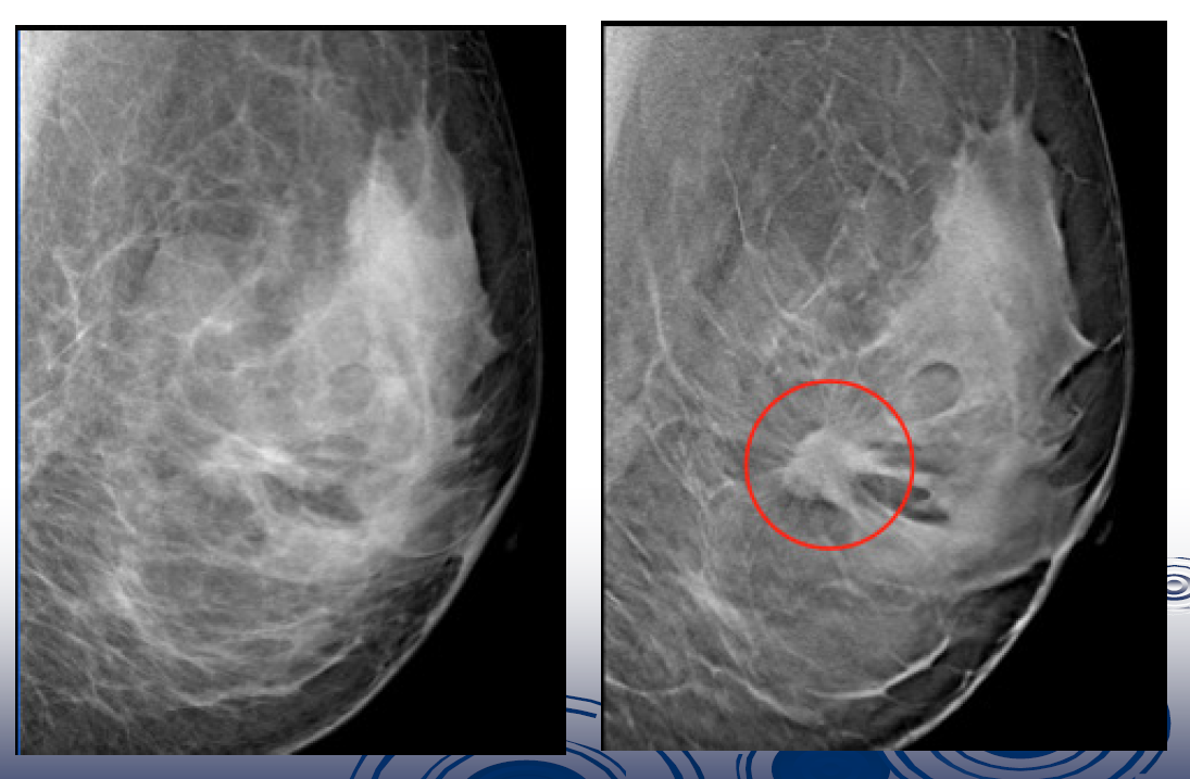 Фиброзно-кистозная мастопатия маммография. Кистозно фиброзная мастопатия на маммографии. Узловая кистозная мастопатия молочных желез. Узловая мастопатия на маммографии.