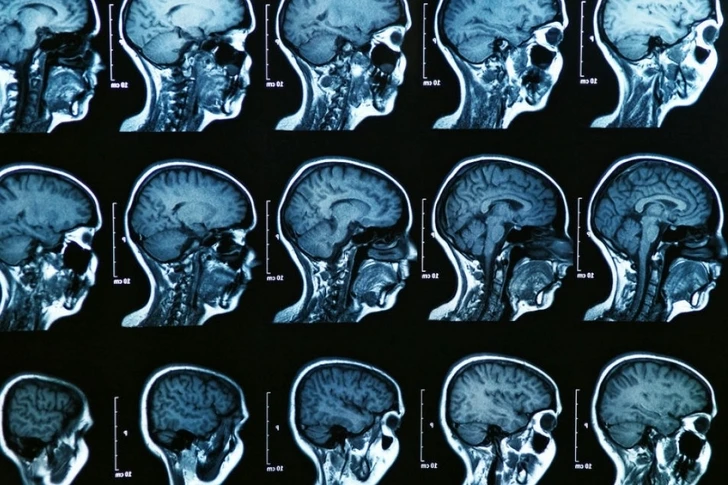 Ученые открыли лекарство от болезни Альцгеймера