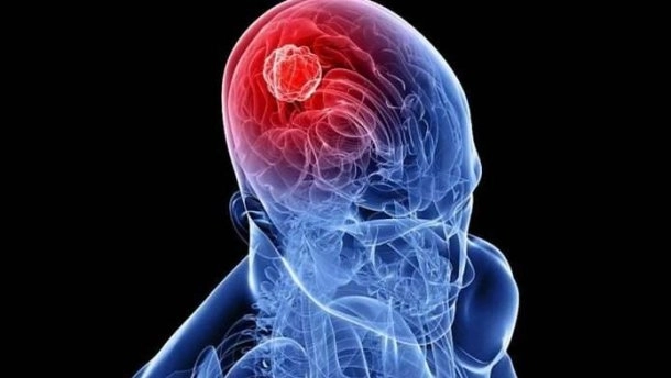 Больные раком мозга назвали симптомы, которые изначально игнорировали