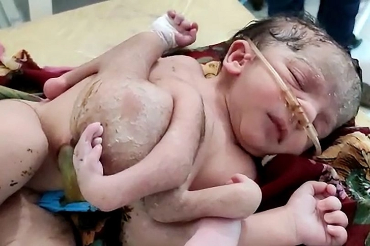 В Индии родился ребенок с четырьмя ногами и тремя руками - ФОТО