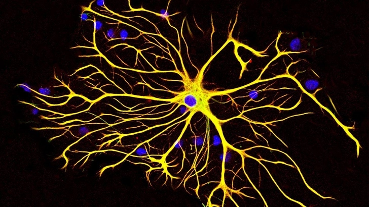 Медики показали, что раковые клетки способны напрямую «подключаться» к нейронам головного мозга