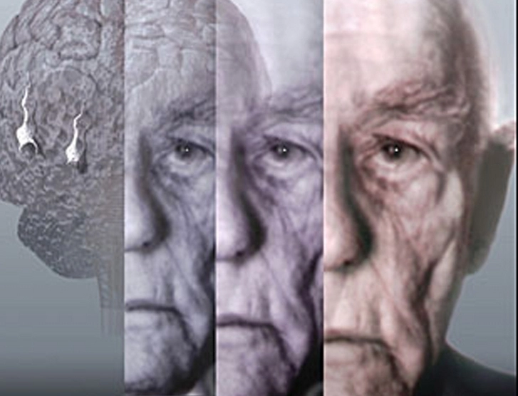 Ученые определили, где в мозге зарождается болезнь Альцгеймера
