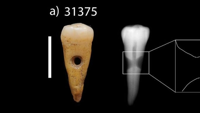 В Турции найдены древние украшения из человеческих зубов