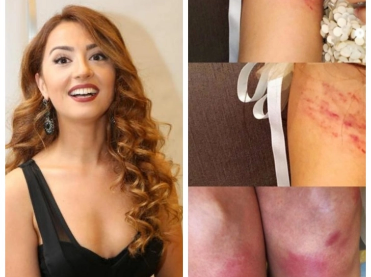 Азербайджанская ведущая показала ужасные раны, полученные на съемках – ФОТО/ВИДЕО