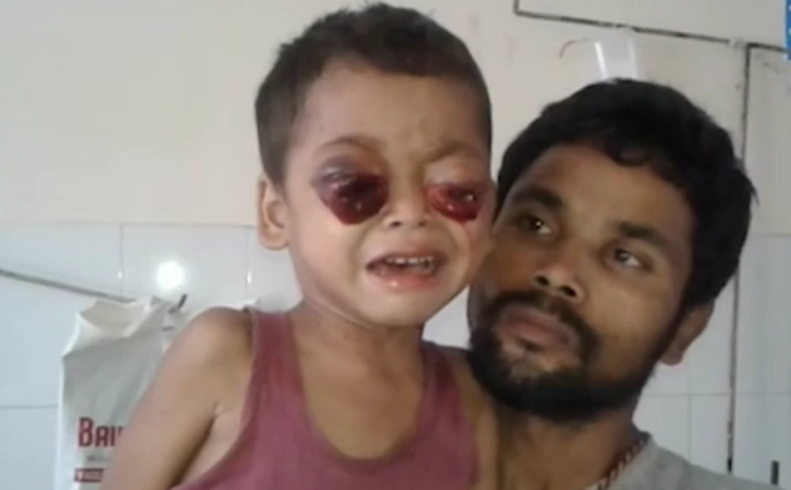 Медицинское чудо в Индии: Мальчику, чьи глаза из-за рака вылезли из орбит, вернули зрение – ФОТО