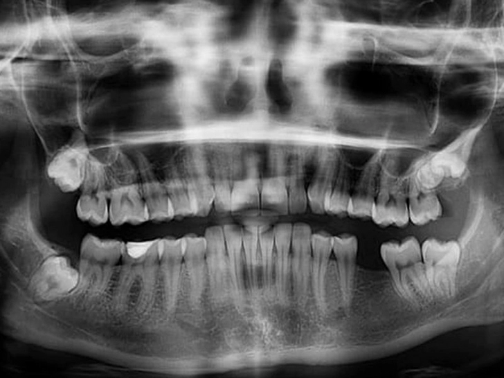 Искусственный интеллект поможет стоматологам в установке имплантантов