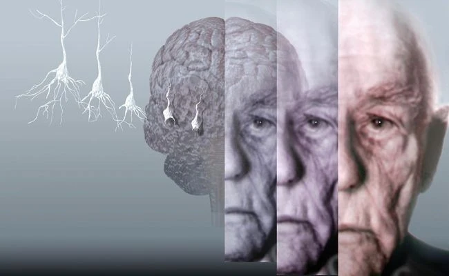 Биологи открыли белок, защищающий мозг от появления болезни Альцгеймера