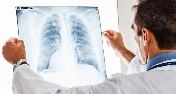 В Азербайджане уменьшилось число больных туберкулезом