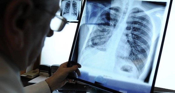 В ВОЗ считают маловероятным искоренение туберкулеза к 2030 году