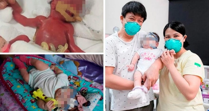 В Сингапуре из больницы выписали девочку, родившуюся весом в 212 грамм