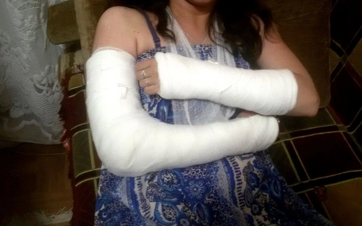 В Баку мужчина избил свою невесту, у девушки переломаны обе руки
