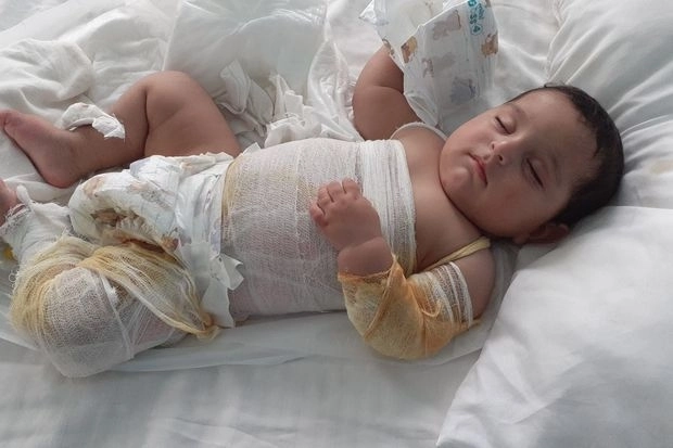 Семимесячный малыш получил тяжелые ожоги: для лечения нужно 2 500 манатов - ФОТО