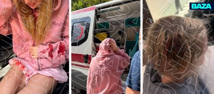 Media.az - Новости Азербайджана - В Габале туристка получила травму головы, фотографируясь с обезьяной