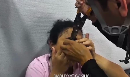Необычный вызов в Баку: веко девушки застряло в застежке-молнии