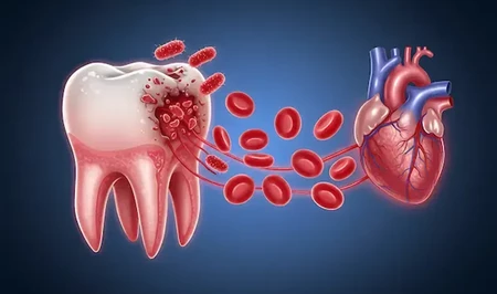Кариес в детстве может аукнуться инфарктом: масштабное исследование выявило неожиданную связь