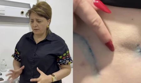 Очередной скандал с «пластическим хирургом» в Азербайджане: пациентка жалуется на гниение тканей